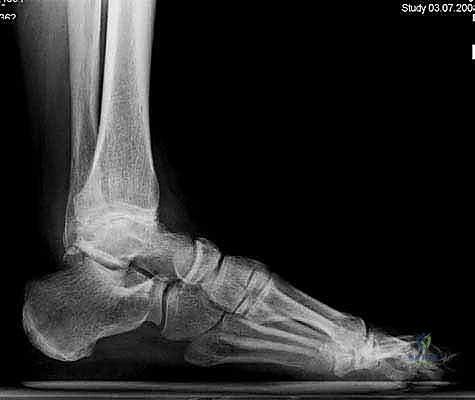 جراحة الكاحل المتقدمة