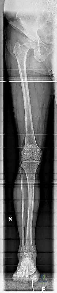 استعادة الحركة بعد الجراحة