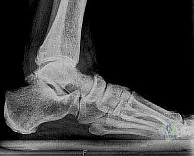 تشريح مفصل الكاحل