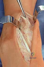 تآكل مفصل الكاحل المتقدم