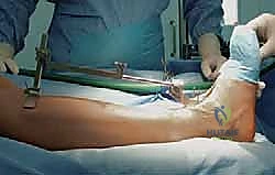 كسور الكاحل القديمة