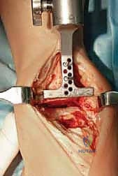 تشخيص خشونة الكاحل