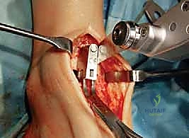 تأثير الروماتويد على الكاحل