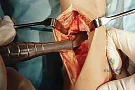 الحفاظ على الأنسجة المحيطة