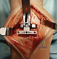 الحذاء الطبي الداعم