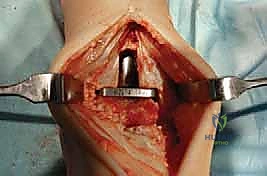 صورة توضيحية لـ استبدال مفصل الكاحل الكلي: استعادة الحركة والتخلص من الألم مع الأستاذ الدكتور محمد هطيف