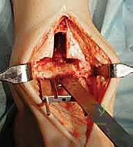 صورة طبية: استبدال مفصل الكاحل الكلي: استعادة الحركة والتخلص من الألم مع الأستاذ الدكتور محمد هطيف