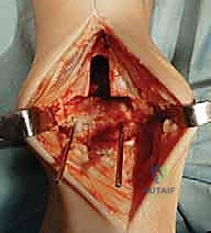 تركيب أجزاء المفصل الصناعي