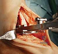 إغلاق الجرح الجراحي