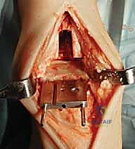 تقوية عضلات الساق