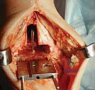 مفصل الكاحل الصناعي