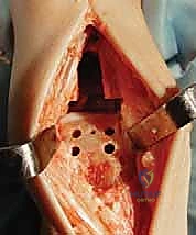 صورة توضيحية لـ استبدال مفصل الكاحل الكلي: استعادة الحركة والتخلص من الألم مع الأستاذ الدكتور محمد هطيف