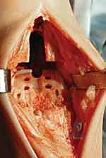 وضع الجبيرة الواقية