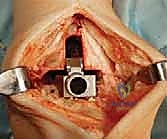 رفع القدم وتقليل التورم