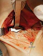 التأكد من حركة المفصل الصناعي