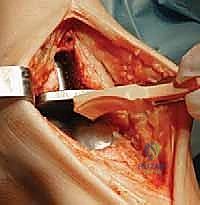 المشي بدون ألم بعد استبدال الكاحل