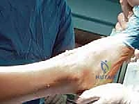 استبدال مفصل الكاحل الكلي: استعادة الحركة والتخلص من الألم مع الأستاذ الدكتور محمد هطيف