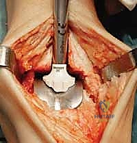 صورة طبية: استبدال مفصل الكاحل الكلي: استعادة الحركة والتخلص من الألم مع الأستاذ الدكتور محمد هطيف