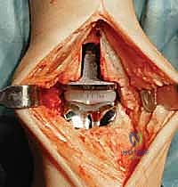 صورة توضيحية لـ استبدال مفصل الكاحل الكلي: استعادة الحركة والتخلص من الألم مع الأستاذ الدكتور محمد هطيف