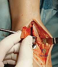 تجهيز عظام الكاحل