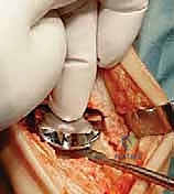 صورة طبية: استبدال مفصل الكاحل الكلي: استعادة الحركة والتخلص من الألم مع الأستاذ الدكتور محمد هطيف