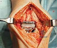 صورة طبية: استبدال مفصل الكاحل الكلي: استعادة الحركة والتخلص من الألم مع الأستاذ الدكتور محمد هطيف