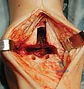 استخدام الأدوات الجراحية الدقيقة