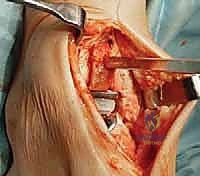 صورة توضيحية لـ استبدال مفصل الكاحل الكلي: استعادة الحركة والتخلص من الألم مع الأستاذ الدكتور محمد هطيف