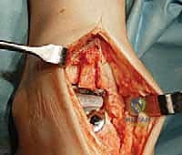 تثبيت المفصل في الكاحل