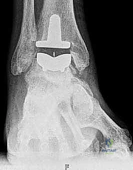 صورة توضيحية لـ استبدال مفصل الكاحل الكلي: استعادة الحركة والتخلص من الألم مع الأستاذ الدكتور محمد هطيف