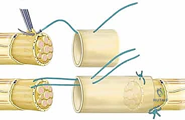 إصابات الأعصاب الطرفية في اليد والمعصم والساعد: دليل شامل لترميم الأعصاب واستعادة الوظيفة مع الأستاذ الدكتور محمد هطيف