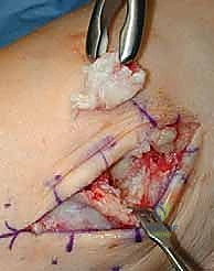 الأعراض التحذيرية لخشونة الكاحل المتقدمة