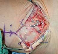 الأستاذ الدكتور محمد هطيف أثناء إجراء عملية جراحية معقدة