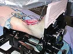 إزالة الغضروف التالف وتحضير سطح العظم