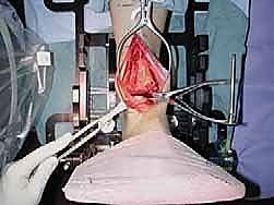 إدخال الساق المعيارية داخل القناة النخاعية