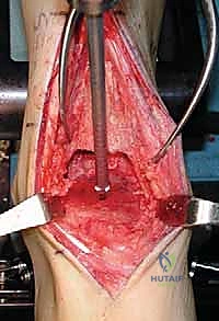 جلسات العلاج الطبيعي والتأهيل بعد عملية استبدال الكاحل