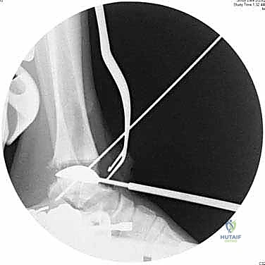 تصميم نظام INBONE المبتكر لاستبدال الكاحل