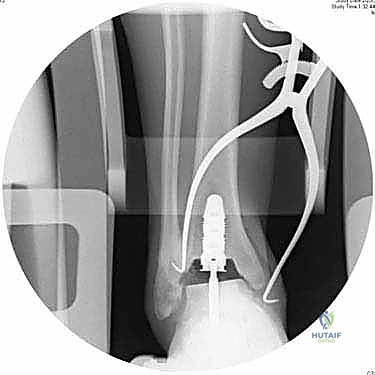صورة توضيحية لـ استبدال مفصل الكاحل الكلي بنظام INBONE: استعادة الحركة بلا ألم مع الأستاذ الدكتور محمد هطيف في صنعاء
