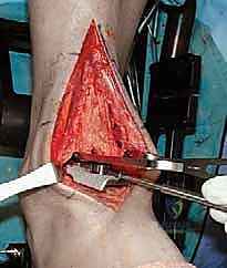 إغلاق الجرح ووضع الجبيرة الواقية