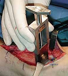 صورة شعاعية توضح الفرق بين الإيثاق والاستبدال