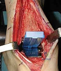 صورة توضيحية لـ استبدال مفصل الكاحل الكلي بنظام INBONE: استعادة الحركة بلا ألم مع الأستاذ الدكتور محمد هطيف في صنعاء