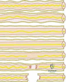 أسباب إصابات الأعصاب الطرفية