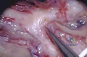 إصابات الأعصاب المتصلة: دليل شامل لعمليات تحرير العصب والإصلاح الجزئي مع الأستاذ الدكتور محمد هطيف