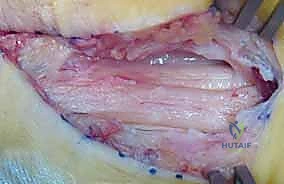 تقييم العصب المجهري