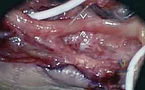 التشريح المجهري للعصب الطرفي