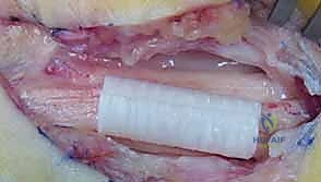 الإصلاح الجزئي للعصب - خطوة 2