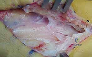 صورة توضيحية لـ إصابات الأعصاب المتصلة