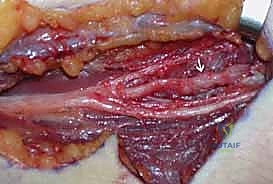 نتائج الجراحة المبهرة