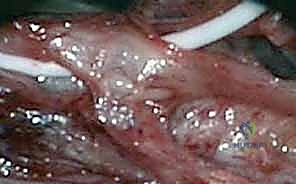 تحفيز العصب أثناء الجراحة