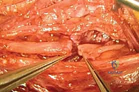 تمارين الانزلاق العصبي